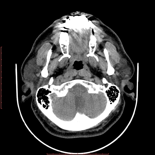 Chronic submandibular sialolithiasis (Radiopaedia 69817-79814 Axial non-contrast 37).jpg
