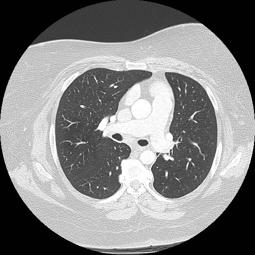 Cicatrisation collapse (Radiopaedia 17405-17089 lung window 49).jpg