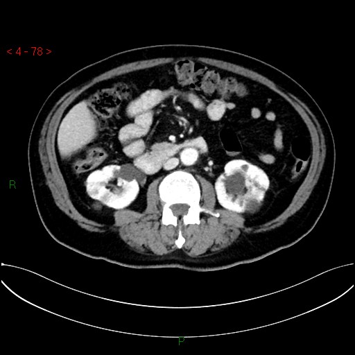 File:Circumaortic left renal vein and doubled left renal arteries (Radiopaedia 52268-58158 B 38).jpg