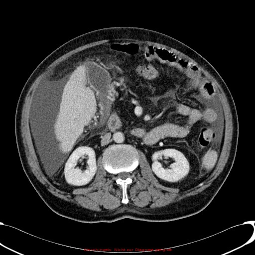 Cirrhosis and hepatocellular carcinoma in the setting of hemochromatosis (Radiopaedia 75394-86595 B 42).jpg