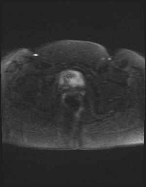 Class II Mullerian duct anomaly- unicornuate uterus with rudimentary horn and non-communicating cavity (Radiopaedia 39441-41755 Axial DWI 55).jpg
