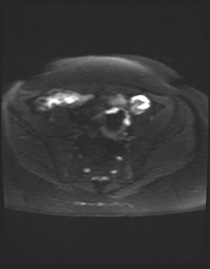 File:Class II Mullerian duct anomaly- unicornuate uterus with rudimentary horn and non-communicating cavity (Radiopaedia 39441-41755 Axial DWI 8).jpg