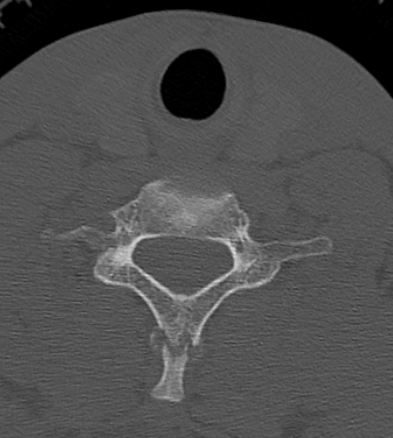 Clay-shoveler fracture (Radiopaedia 14604-14532 Axial bone window 29).jpg