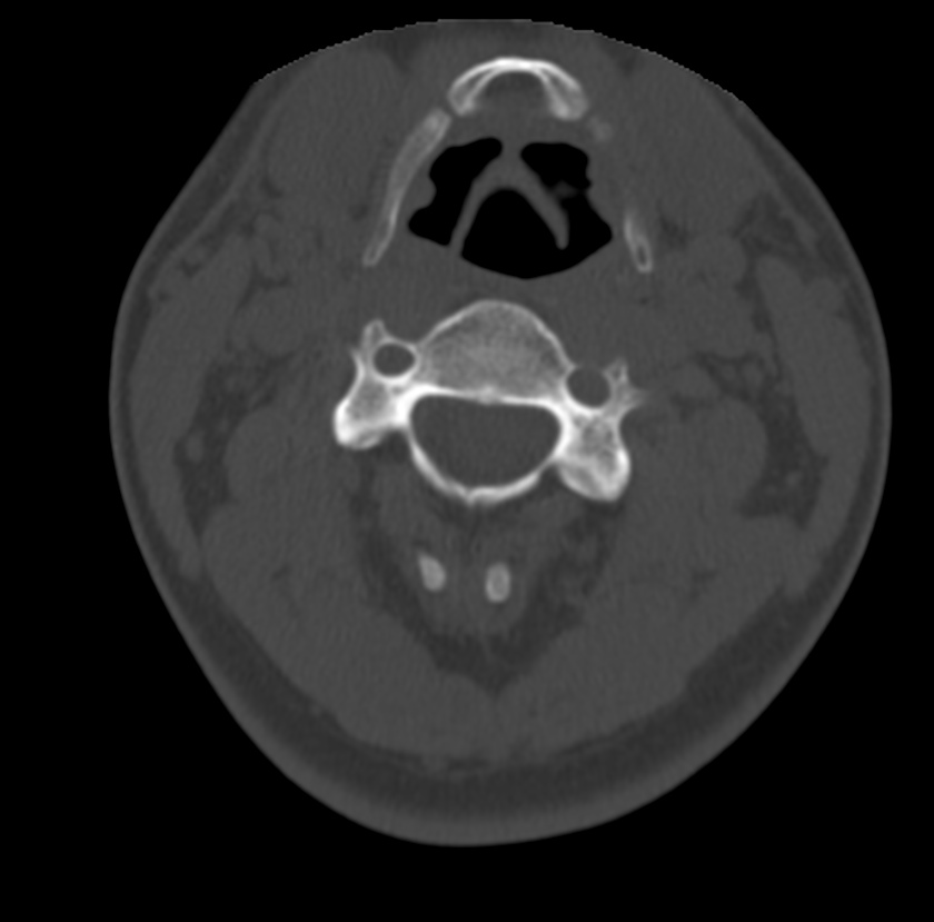 Clay-shoveler fracture (Radiopaedia 22568-22590 Axial bone window 26).jpg
