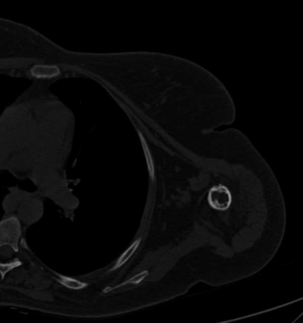 Clear cell chondrosarcoma - humerus (Radiopaedia 63104-71612 Axial bone window 73).jpg