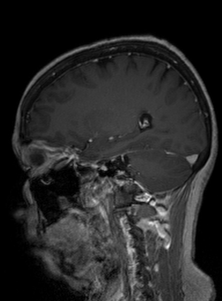 Clival meningioma (Radiopaedia 53278-59248 Sagittal T1 C+ 213).jpg