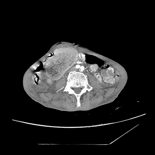 Closed-loop obstruction due to peritoneal seeding mimicking internal hernia after total gastrectomy (Radiopaedia 81897-95864 A 122).jpg