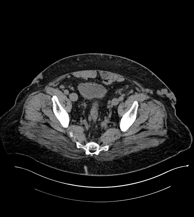 Closed-loop small bowel obstruction-internal hernia (Radiopaedia 78439-91096 Axial non-contrast 133).jpg