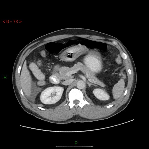 File:Closed loop obstruction and appendicular stump mucocele (Radiopaedia 54014-60163 A 37).jpg