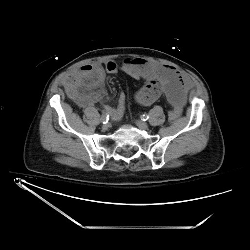 Closed loop obstruction due to adhesive band, resulting in small bowel ischemia and resection (Radiopaedia 83835-99023 Axial non-contrast 111).jpg
