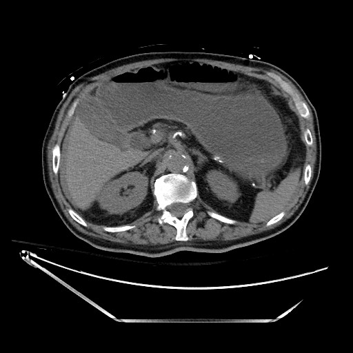 Closed loop obstruction due to adhesive band, resulting in small bowel ischemia and resection (Radiopaedia 83835-99023 Axial non-contrast 48).jpg