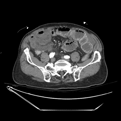 Closed loop obstruction due to adhesive band, resulting in small bowel ischemia and resection (Radiopaedia 83835-99023 B 107).jpg