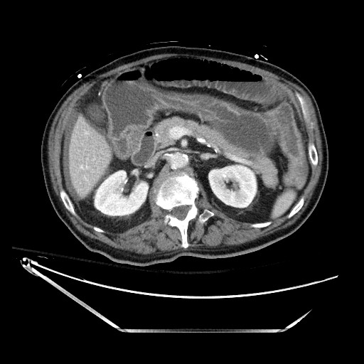 Closed loop obstruction due to adhesive band, resulting in small bowel ischemia and resection (Radiopaedia 83835-99023 D 57).jpg