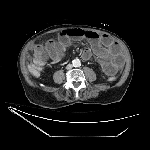 Closed loop obstruction due to adhesive band, resulting in small bowel ischemia and resection (Radiopaedia 83835-99023 D 89).jpg