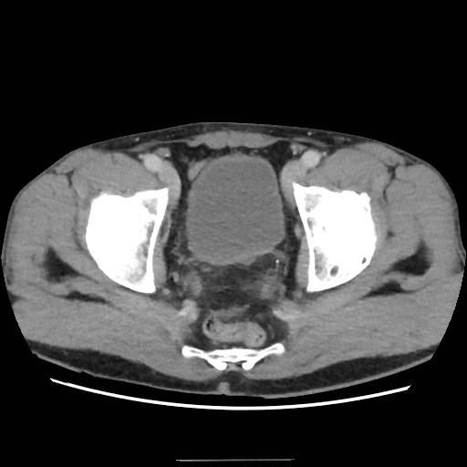 File:Closed loop small bowel obstruction (Radiopaedia 59227-66554 A 77).jpg
