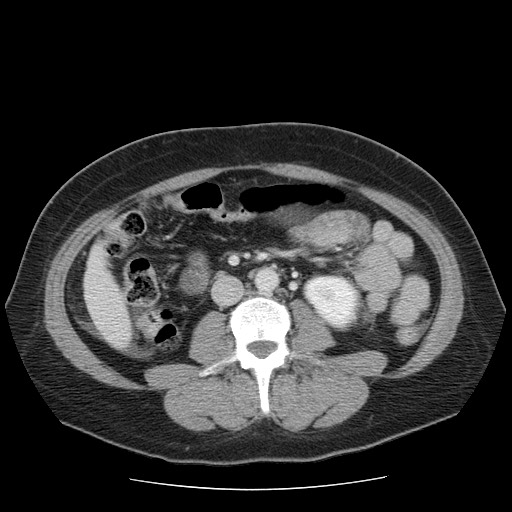 File:Closed loop small bowel obstruction (Radiopaedia 65403-74451 A 41).jpg