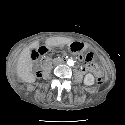 Closed loop small bowel obstruction - adhesions and infarct (Radiopaedia 85125-100678 A 91).jpg