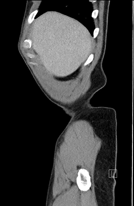 Closed loop small bowel obstruction - internal hernia (Radiopaedia 57806-64778 C 103).jpg
