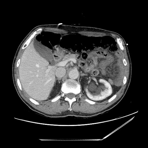 Closed loop small bowel obstruction - omental adhesion causing "internal hernia" (Radiopaedia 85129-100682 A 45).jpg