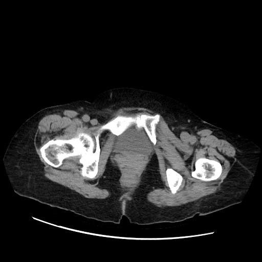Closed loop small bowel obstruction due to adhesive band, with intramural hemorrhage and ischemia (Radiopaedia 83831-99017 Axial non-contrast 159).jpg