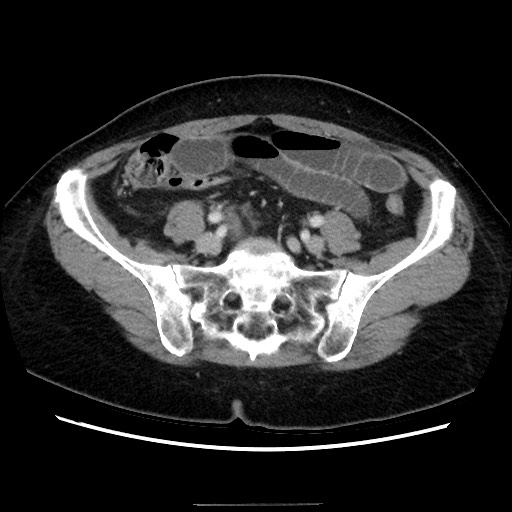 Closed loop small bowel obstruction due to adhesive bands - early and late images (Radiopaedia 83830-99015 A 121).jpg