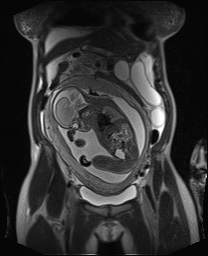 File:Closed loop small bowel obstruction in pregnancy (MRI) (Radiopaedia 87637-104031 Coronal T2 22).jpg