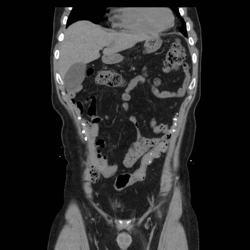 File:Colocutaneous fistula in Crohn's disease (Radiopaedia 29586-30093 Coronal non-contrast 2).jpg