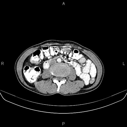 Colon adenocarcinoma - hepatic flexure (Radiopaedia 85635-101395 A 47).jpg
