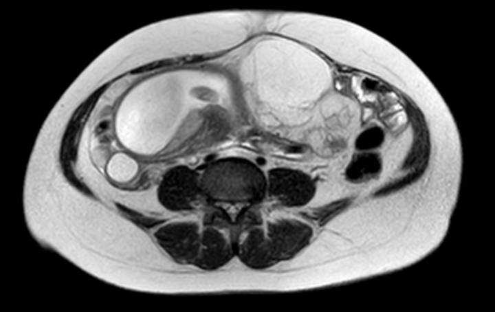 File:Colon adenocarcinoma with Krukenberg tumors, advanced pregnancy (Radiopaedia 67279-76645 Axial T2 33).jpg