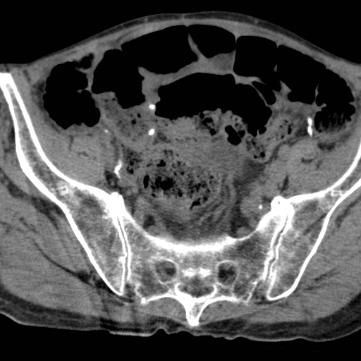 File:Colon cancer with calcified liver metastasis (Radiopaedia 74423-85309 Axial non-contrast 91).jpg