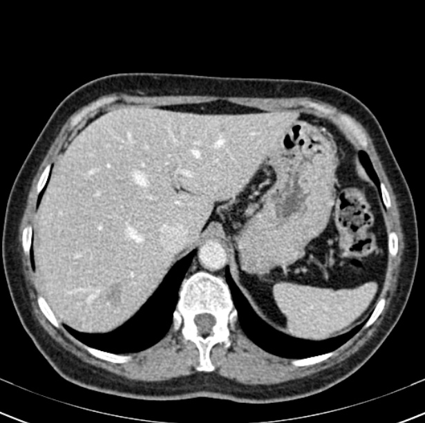 Colon carcinoma with hepatic metastases (Radiopaedia 29477-29961 A 22).jpg