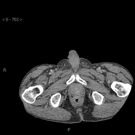 File:Colonic cancer (ultrasound and TC imaging) (Radiopaedia 50346-55713 A 159).jpg