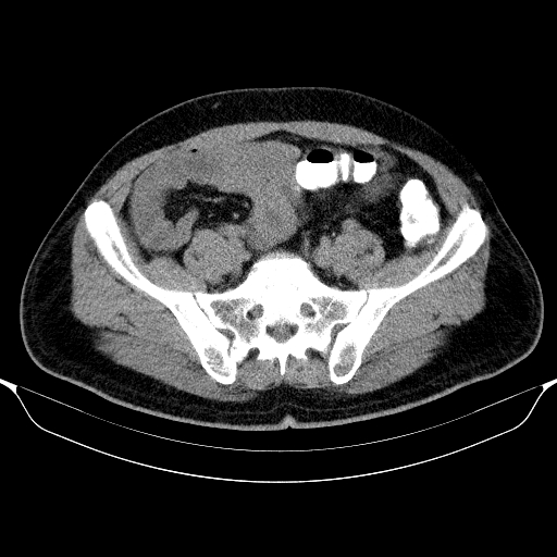 Colonic lipoma with colo-colic intussusception (Radiopaedia 58944-66200 Axial C+ rectal 52).jpg