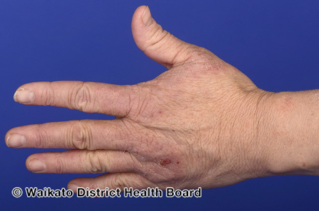 File:Hand dermatitis (DermNet NZ irritant-contact-dermatitis-002).jpg