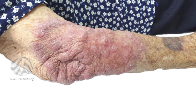 File:Indurated plaque on forearm due to Balamuthia mandrillaris infection (DermNet NZ balamuthia-mandrillaris-figure-1).jpg
