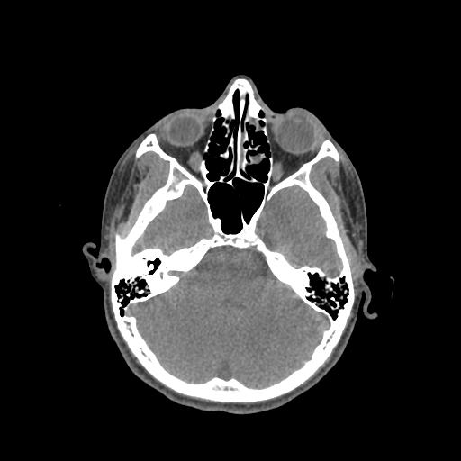 Nasal pyogenic granuloma (lobular capillary hemangioma) (Radiopaedia 85536-101244 Axial non-contrast 93).jpg