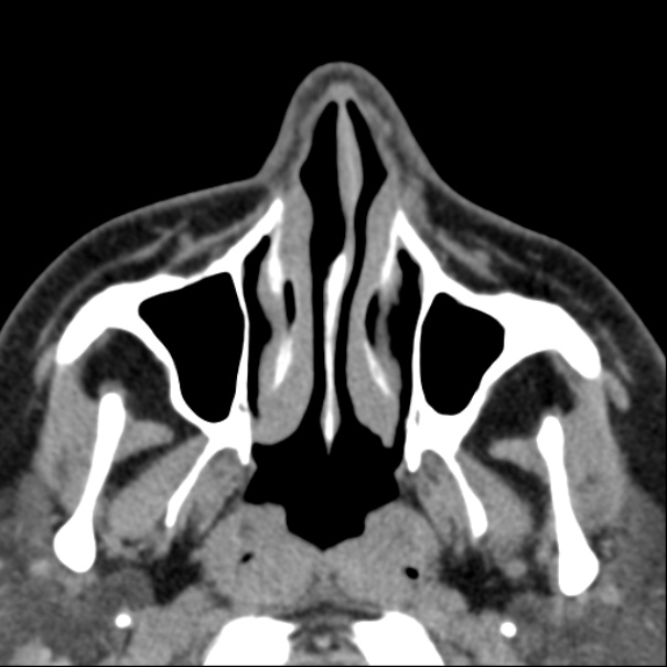 Nasolabial cyst (Radiopaedia 33987-35205 Axial non-contrast 14).jpg