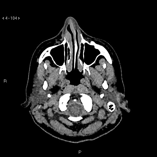 Nasolabial cyst (Radiopaedia 75125-86194 Axial non-contrast 66).jpg