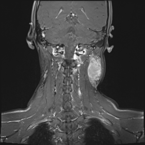 Nasopharyngeal carcinoma with skull base invasion (Radiopaedia 53415-59485 E 6).jpg