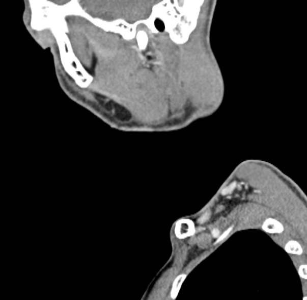 File:Nasopharyngeal carcinoma with skull base invasion (Radiopaedia 53415-59705 C 64).jpg