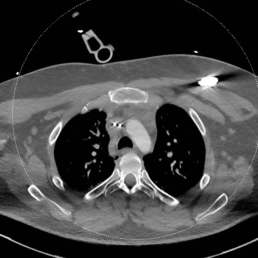 Neck CT angiogram (intraosseous vascular access) (Radiopaedia 55481-61945 B 56).jpg
