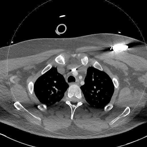 Neck CT angiogram (intraosseous vascular access) (Radiopaedia 55481-61945 B 69).jpg
