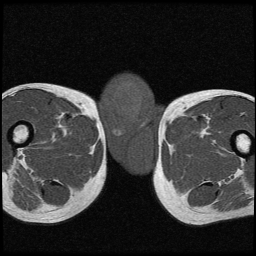 File:Necrotizing epididymo-orchitis with intra-testicular abscess (Radiopaedia 29397-29860 Axial T1 15).jpg