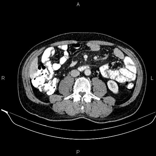 Necrotizing pancreatitis (Radiopaedia 87796-104249 A 30).jpg