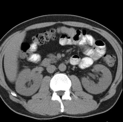 File:Necrotizing pancreatitis with acute necrotic collection (Radiopaedia 14470-14417 Axial non-contrast 20).jpg