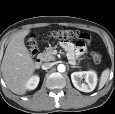 File:Necrotizing pancreatitis with acute necrotic collection (Radiopaedia 14470-14417 B 13).jpg