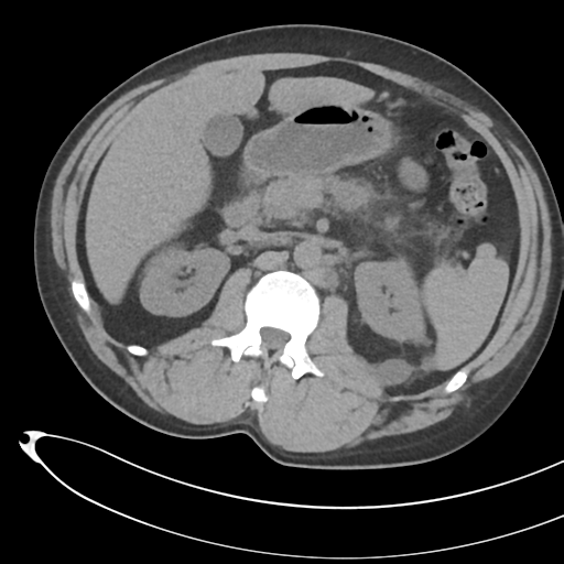File:Necrotizing pancreatitis with acute necrotic collections (Radiopaedia 38829-41012 Axial non-contrast 32).png