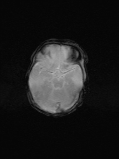 File:Neonatal hypoxic-ischemic encephalopathy (Radiopaedia 41406-44277 Axial Gradient Echo 13).jpg