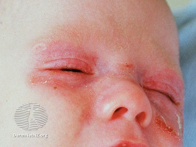 File:Neonatal lupus (DermNet NZ immune-lupus-neon).jpg