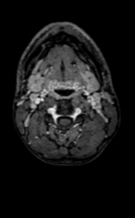 Neuro-Behçet disease (Radiopaedia 90112-107294 Axial T1 C+ 250).jpg